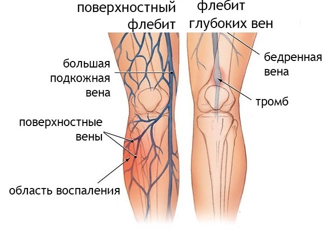 Варикоз Шишка